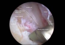 Why You Might Actually Need an Arthroscopic Surgeon (And Why It’s Not as Scary as You Think) arthroscopic surgeon